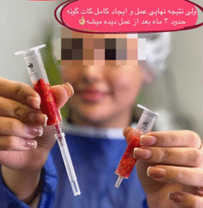 نمونه عمل بوکال فت کلینیک زیبایی آرمان