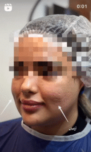 نمونه عمل بوکال فت کلینیک زیبایی آرمان