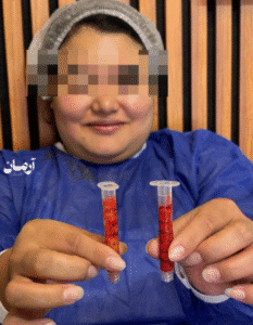 نمونه عمل بوکال فت کلینیک زیبایی آرمان