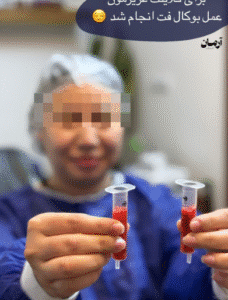 نمونه عمل بوکال فت کلینیک زیبایی آرمان
