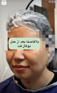 نمونه عمل بوکال فت کلینیک زیبایی آرمان