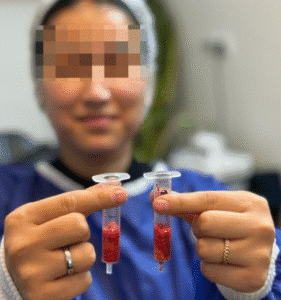 نمونه عمل بوکال فت کلینیک زیبایی آرمان