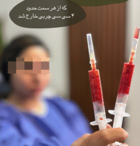 نمونه عمل بوکال فت کلینیک زیبایی آرمان