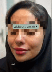 نمونه عمل بوکال فت کلینیک زیبایی آرمان