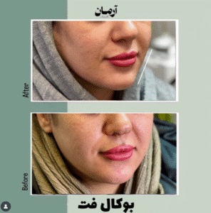نمونه عمل بوکال فت کلینیک زیبایی آرمان