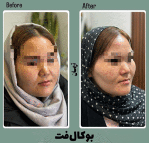 نمونه عمل بوکال فت کلینیک زیبایی آرمان