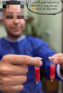 نمونه عمل بوکال فت کلینیک زیبایی آرمان