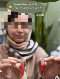 نمونه عمل بوکال فت کلینیک زیبایی آرمان