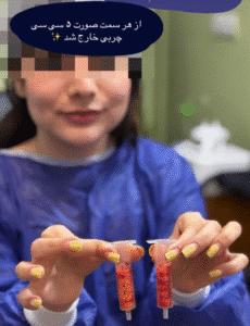 نمونه عمل بوکال فت کلینیک زیبایی آرمان