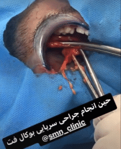 نمونه عمل بوکال فت کلینیک زیبایی سمن