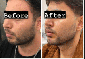 نمونه عمل بوکال فت کلینیک زیبایی سمن