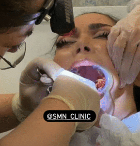 نمونه عمل بوکال فت کلینیک زیبایی سمن