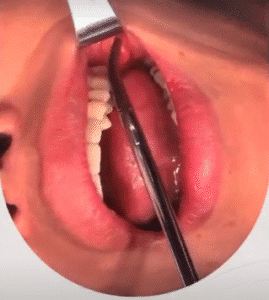 نمونه عمل بوکال فت کلینیک زیبایی سمن