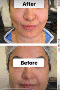 نمونه عمل بوکال فت کلینیک زیبایی سمن