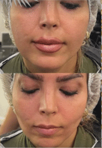 نمونه عمل بوکال فت کلینیک زیبایی سمن