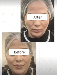 نمونه عمل بوکال فت کلینیک زیبایی سمنر