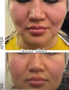 نمونه عمل بوکال فت کلینیک زیبایی سمن