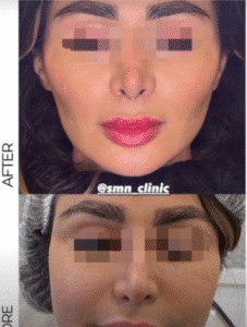 نمونه عمل بوکال فت کلینیک زیبایی سمن