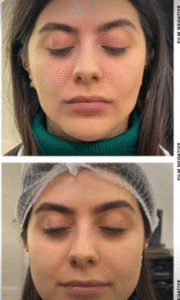 نمونه عمل بوکال فت کلینیک زیبایی سمن