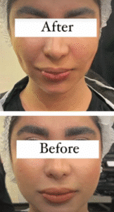 نمونه عمل بوکال فت کلینیک زیبایی سمن