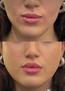 نمونه عمل بوکال فت کلینیک زیبایی سمن