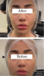 نمونه عمل بوکال فت کلینیک زیبایی سمن