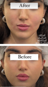 نمونه عمل بوکال فت کلینیک زیبایی سمن