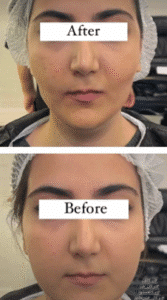 نمونه عمل بوکال فت کلینیک زیبایی سمن