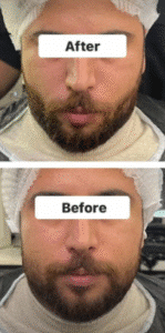 نمونه عمل بوکال فت کلینیک زیبایی سمن