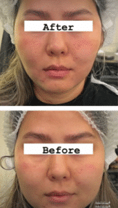 نمونه عمل بوکال فت کلینیک زیبایی سمن