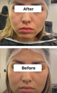 نمونه عمل بوکال فت کلینیک زیبایی سمن