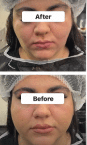 نمونه عمل بوکال فت کلینیک زیبایی سمن