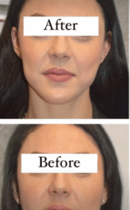 نمونه عمل بوکال فت کلینیک زیبایی سمن