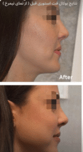 نمونه عمل بوکال فت کلینیک زیبایی سمن