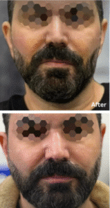 نمونه عمل بوکال فت کلینیک زیبایی سمن