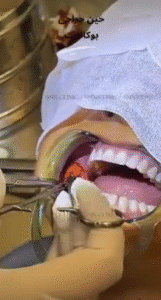 نمونه عمل بوکال فت کلینیک زیبایی سمن