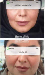 نمونه عمل بوکال فت کلینیک زیبایی سمن