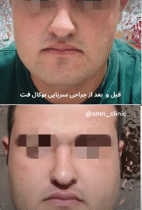 نمونه عمل بوکال فت کلینیک زیبایی سمن