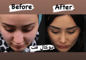 نمونه جراحی بوکال فت دکتر توحید صداقت