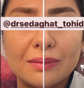 نمونه جراحی بوکال فت دکتر توحید صداقت