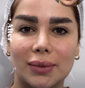 نمونه جراحی بوکال فت دکتر توحید صداقت