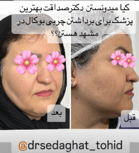 نمونه جراحی بوکال فت دکتر توحید صداقت