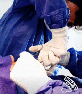 نمونه تخلیه چربی بوکال کلینیک زیبایی آفرینش