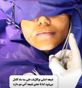 نمونه تخلیه چربی بوکال کلینیک زیبایی آفرینش