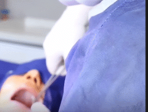 نمونه تخلیه چربی بوکال کلینیک زیبایی آفرینش