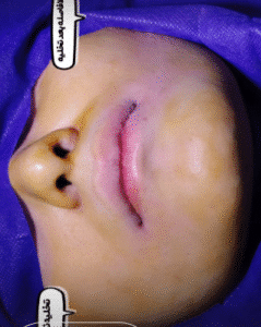 نمونه تخلیه چربی بوکال کلینیک زیبایی آفرینش