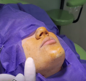 نمونه تخلیه چربی بوکال کلینیک زیبایی آفرینش