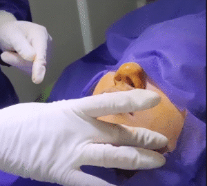 نمونه تخلیه چربی بوکال کلینیک زیبایی آفرینش