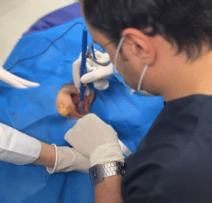 نمونه جراحی بوکال فت دکتر رضا قندهاری (کلینیک زیبایی ماهان)