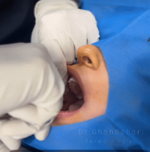 نمونه جراحی بوکال فت دکتر رضا قندهاری (کلینیک زیبایی ماهان)